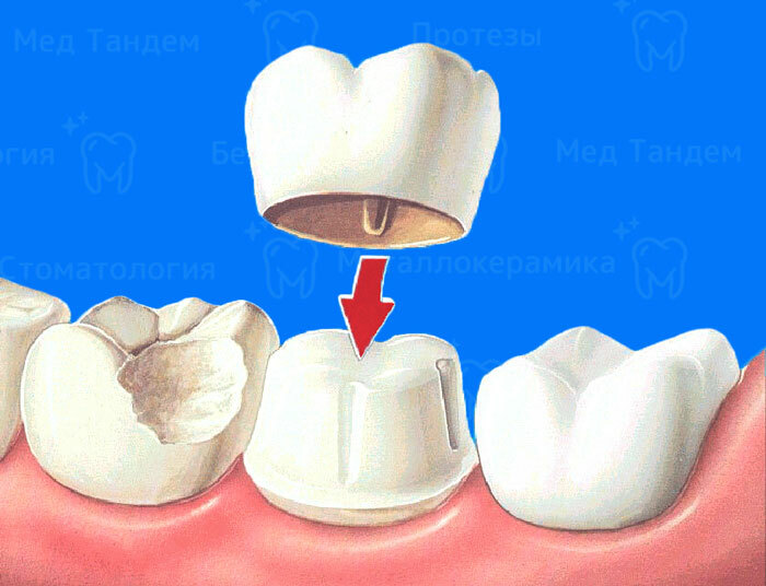 Металлокерамическая коронка под ключ Металлокерамическая коронка под ключ