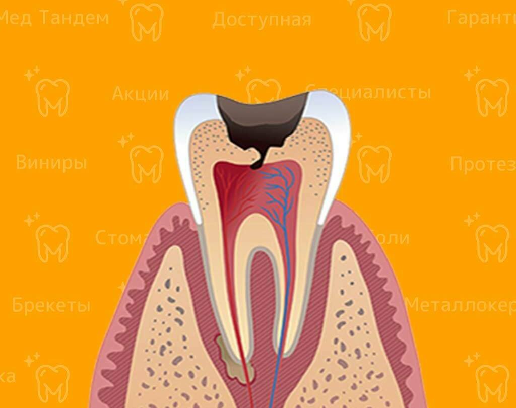 <span style="font-weight: bold;">Лечение кариеса</span><br>
